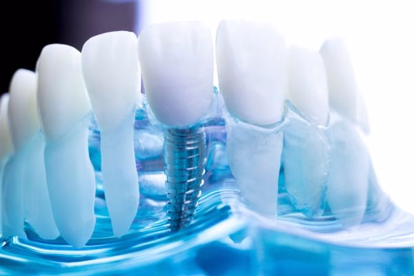 Implantes dentales