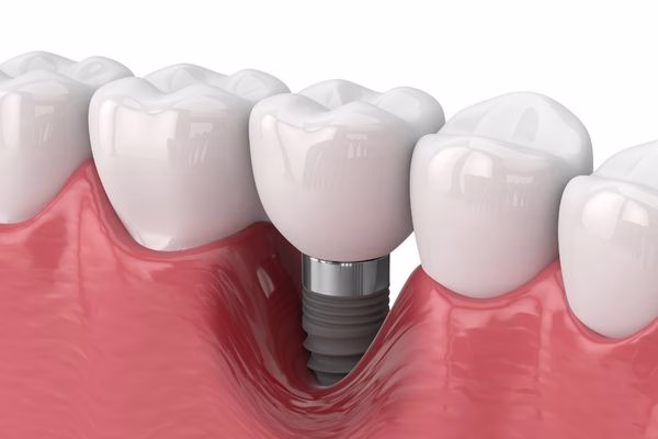 periimplantitis