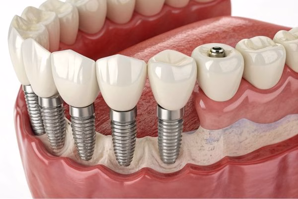 periimplantitis