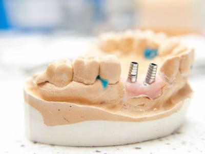 El implante dental es uno de los tratamientos dentales mas solicitados.