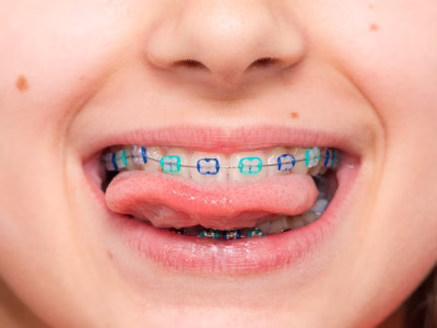 boca con ortodoncia tradicional o brackets metálicos.