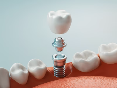 Colocación de un implante dental